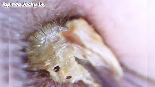 Ear Wax Removal 152 Itchy ears cant sleep  Wet and thick earwax  Ear Cleaning ASMR [upl. by Velleman]