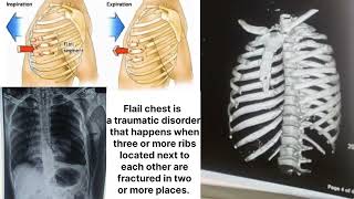 Flail chest  looks like this [upl. by Stricklan]