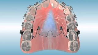 Nitanium® Palatal Expander²™ MultiPurpose Finishing Appliance [upl. by Ayerdna]