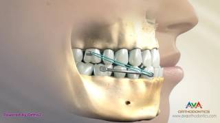 Orthodontic Treatment for Underbite or Crossbite  Carriere Appliance [upl. by Madaih]