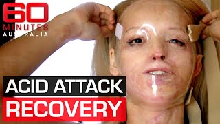 Acid attack survivors inspirational journey to recovery  60 Minutes Australia [upl. by Anauqahc]