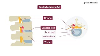 Was ist ein Bandscheibenvorfall [upl. by Titos]