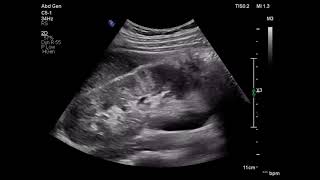 Acute pyelonephritis ultrasound patient with flank pain fever ARDMS sonography [upl. by Nylasoj]