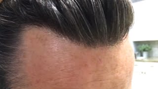 UP CLOSE on my Hairline Hair Replacement or Hair System [upl. by Anaed]