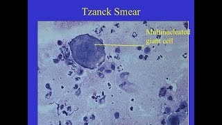 Tzanck smear Positive [upl. by Airotcivairam]