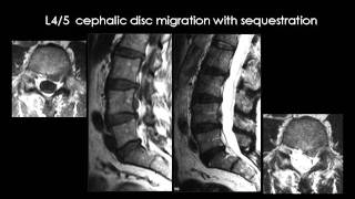 Radiology  Spinal Degenerative disease [upl. by Kessia]