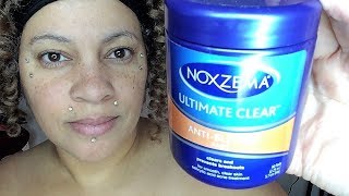 HOW I GOT RID OF ACNE WITH NOXZEMA PADS [upl. by Lithea690]