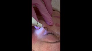 Plexr Plus Plasma Classic Facials [upl. by Shelby]