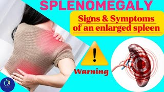 SPLENOMEGALYEnlarged SpleenSymptoms of an enlarged spleen Such as anemia abdominal painetc [upl. by Lenahs]