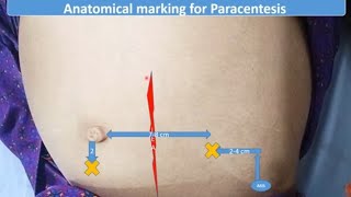 Paracentesis or Ascitic Tap  Pediatrics [upl. by Siroved217]