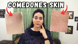 Comedones Skin Treatment  Shamaim Rajpoot [upl. by Neiht]