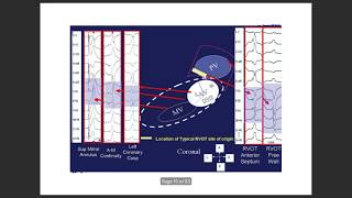 Ventricular tach localisation by ecg VTlocalisation ventriculartachycardia VPC [upl. by Alyahsal342]