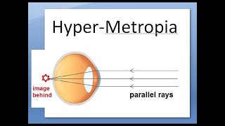 Ophthalmology 044 b HyperMetropia HyperOpia long sightedness Shot silk appearance pseudopapillitis [upl. by Samuelson]