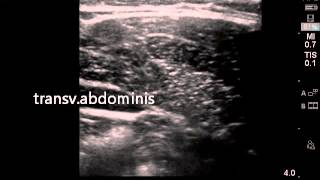 Ultrasound guided transversalis fascia plane block [upl. by Leffert]