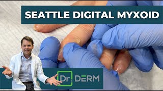 Digital Myxoid from Seattle  Dr Derm [upl. by Roddy160]