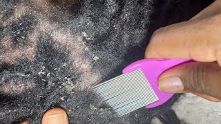 ASMR Extreme Flakes Removal asmrdandruff asmr asmrscalpcheck [upl. by Grissel]