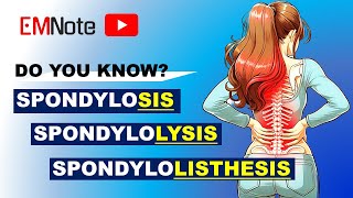 Spondylosis Spondylolysis and Spondylolisthesis [upl. by Mashe66]