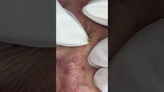 Big Cystic Acne Blackheads Extraction Blackheads amp Milia Whiteheads Removal Pimple Popping shorts [upl. by Daria]