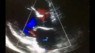 Ecocardiograma Complicaciones del Infarto al miocardio [upl. by Koral]