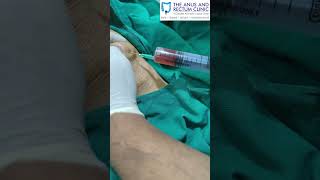 Post trauma PrePatellar Bursitis Aspiration  Dr Syed Nazeeb Ulla [upl. by Flower683]