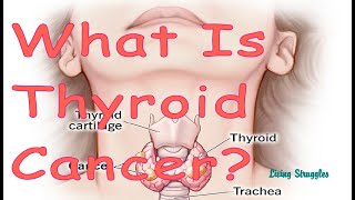 What is Thyroid Cancer [upl. by Rima]