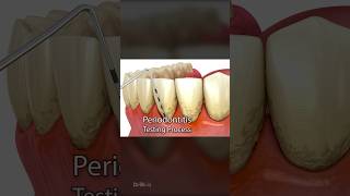 Periodontitis and Laser Hardening Surgery 3D Animation [upl. by Nnylirehs779]