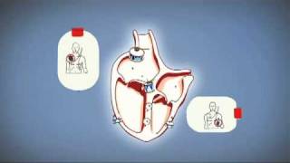 El corazón el paro cardiaco repentino y el uso del desfibrilador [upl. by Dane]