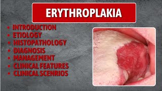 Erythroplakia  Erythroplakia Best Lecture Erythroplakia in depth [upl. by Ecnarolf]