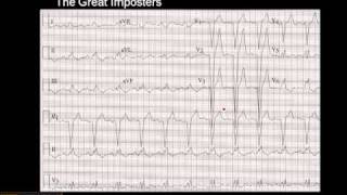 1215 Lead ECG MI Imposter 3 [upl. by Ketchan]