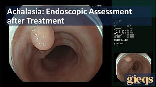 Achalasia Endoscopic Assessment after Treatment [upl. by Millian]