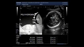 Ultrasound Video showing a Pregnancy of 32 weeks with Polyhydromnios ascites and sluggish fetus [upl. by Aicirtam]