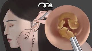 【ASMR animation】Massive Ear Wax removal 丨Mengs Stop Motion [upl. by Eintirb]