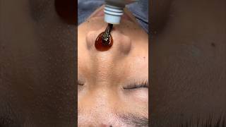 Blackheads amp whitehead removal 5 minutes bridal special mask😱 shorts youtubeshorts skincare [upl. by Abramo784]