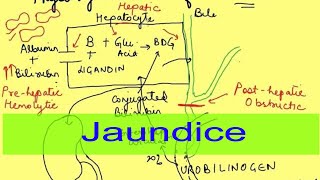 Hemolytic hepatic amp obstructive Jaundice  Icterus  Gastrointestinal Physiology  Pathophysiology [upl. by Adnawal]