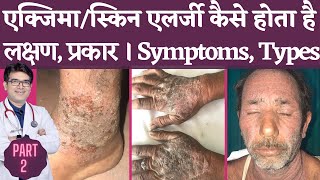 एक्ज़ेमा Symptoms In Hindi  Eczema Types with Pictures  लक्षण और प्रकार  Dermatologist  Jaipur [upl. by Ellednahc]