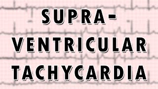 Supraventricular Tachycardia [upl. by Nnaillij]