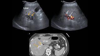 Cavernous transformation of portal vein 간 문맥의 해면성 변화 [upl. by Arateehc]