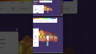 ExocadFirst premolar implant design digitaldentistrywzsamee7 takedigitalstep dentaltechnology [upl. by Drwde]