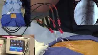 Radiofrequency Ablation Explanation Video Demonstration  LIVE [upl. by Melony342]