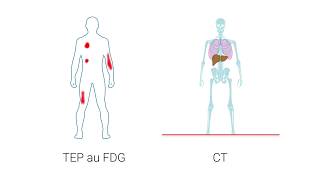 Létude TEP au FDG en médecine nucléaire [upl. by Bendite]