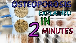 OSTEOPOROSIS  EXPLAINED IN 2 MINUTES  CAUSES  SYMPTOMS  TREATMENT  WHAT IS OSTEOPOROSIS [upl. by Durrace]