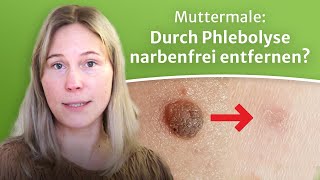 Muttermale und Leberflecke ohne Narbe und schonend entfernt durch Phlebolyse  ein Patientenfall [upl. by Alenson283]