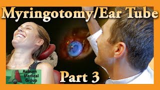 Myringotomy amp Ear Tube Part 3 Tube Placement Feat Dr Tim Fife  Auburn Medical Group [upl. by Deys548]