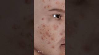 What Exactly Is Acne Causes of Acne 3D Animation [upl. by Nerrej]