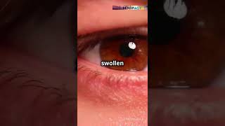 Trachoma The Eye Disease Blinding Millions Worldwide shorts healthtips healthtime6469 [upl. by Fabrice]