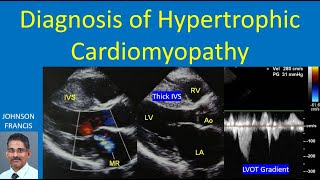 Diagnosis of Hypertrophic Cardiomyopathy [upl. by Nathanoj]