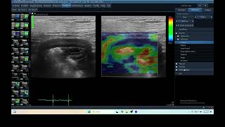 IQ 280 GASTRIC ULTRASOUND ECHOPAC ANALYSIS ELASTOGRAPHY [upl. by Arama]