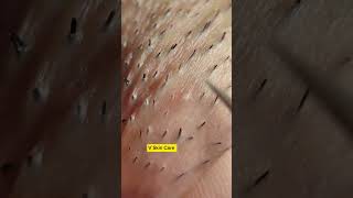 Remove ACNE FAST With These Treatment Secrets 102 dermatologia acne blackheads [upl. by Ydassac]