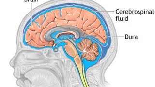 Hydrocephalus  Myelomeningocele  CNS Disorders [upl. by Nahgem]