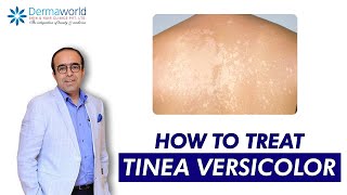 Tinea versicolor  Dr Rohit Batra  Tinea Versicolor Treatment  How to treat Tinea Versicolor [upl. by Myron942]